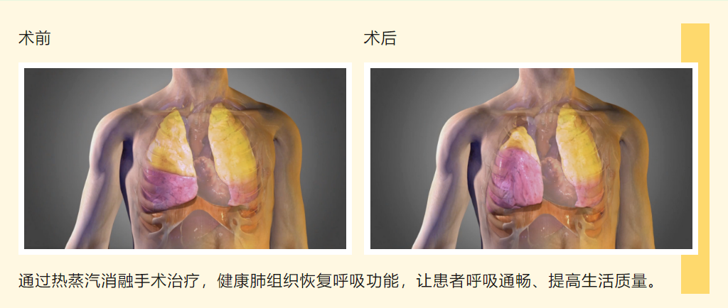 支气管镜“蒸汽盾”激活肺动力——湖北省第三人民医院开展靶向热蒸汽消融术，让慢阻肺患者告别“窒息人生”