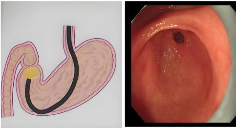 年年体检正常，为何仍罹患晚期胃癌？警惕这些致命误区